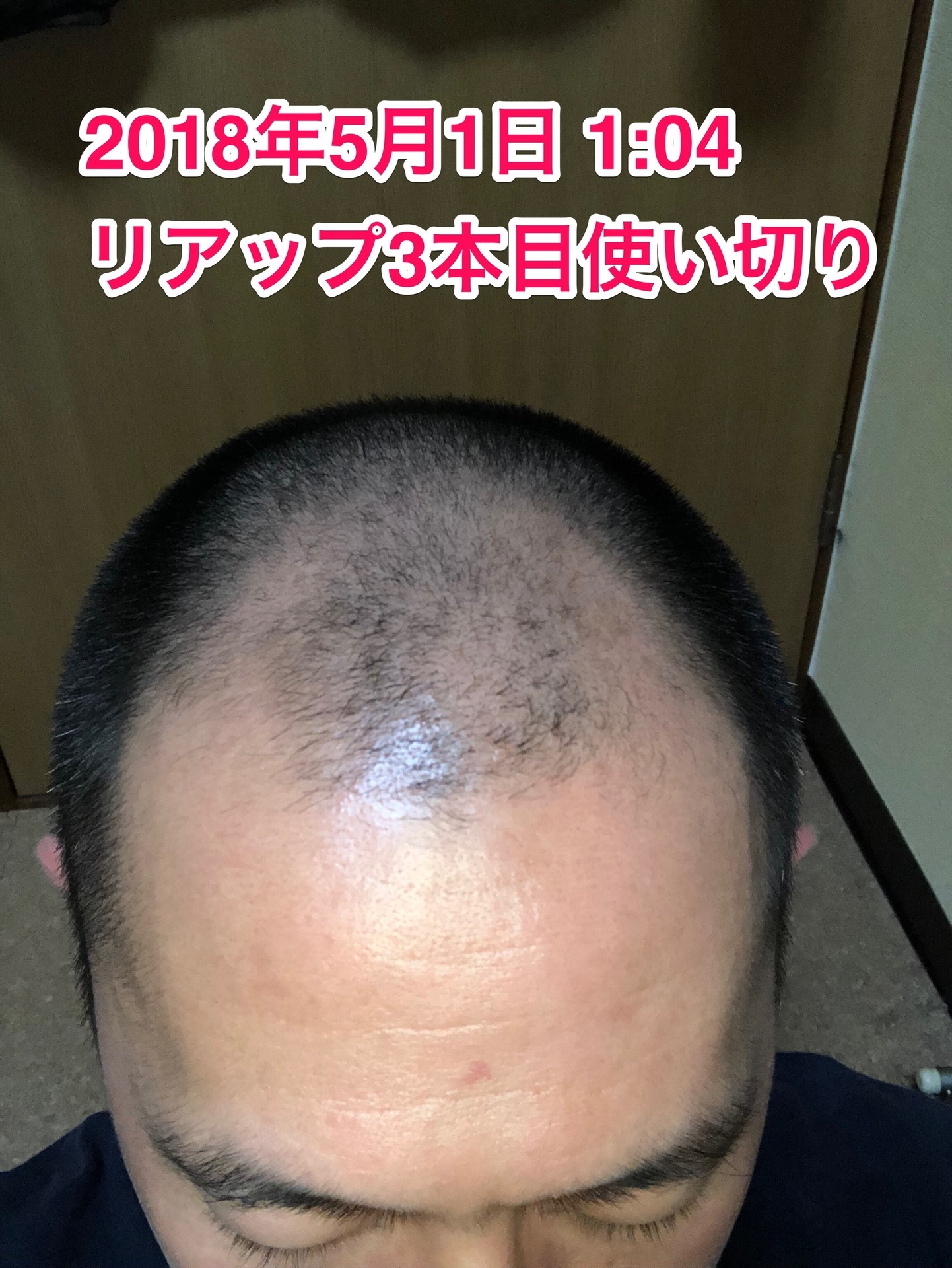 40代オヤジの頭髪を経過観察するブログ 18年5月1日 リアップ3本使い切り