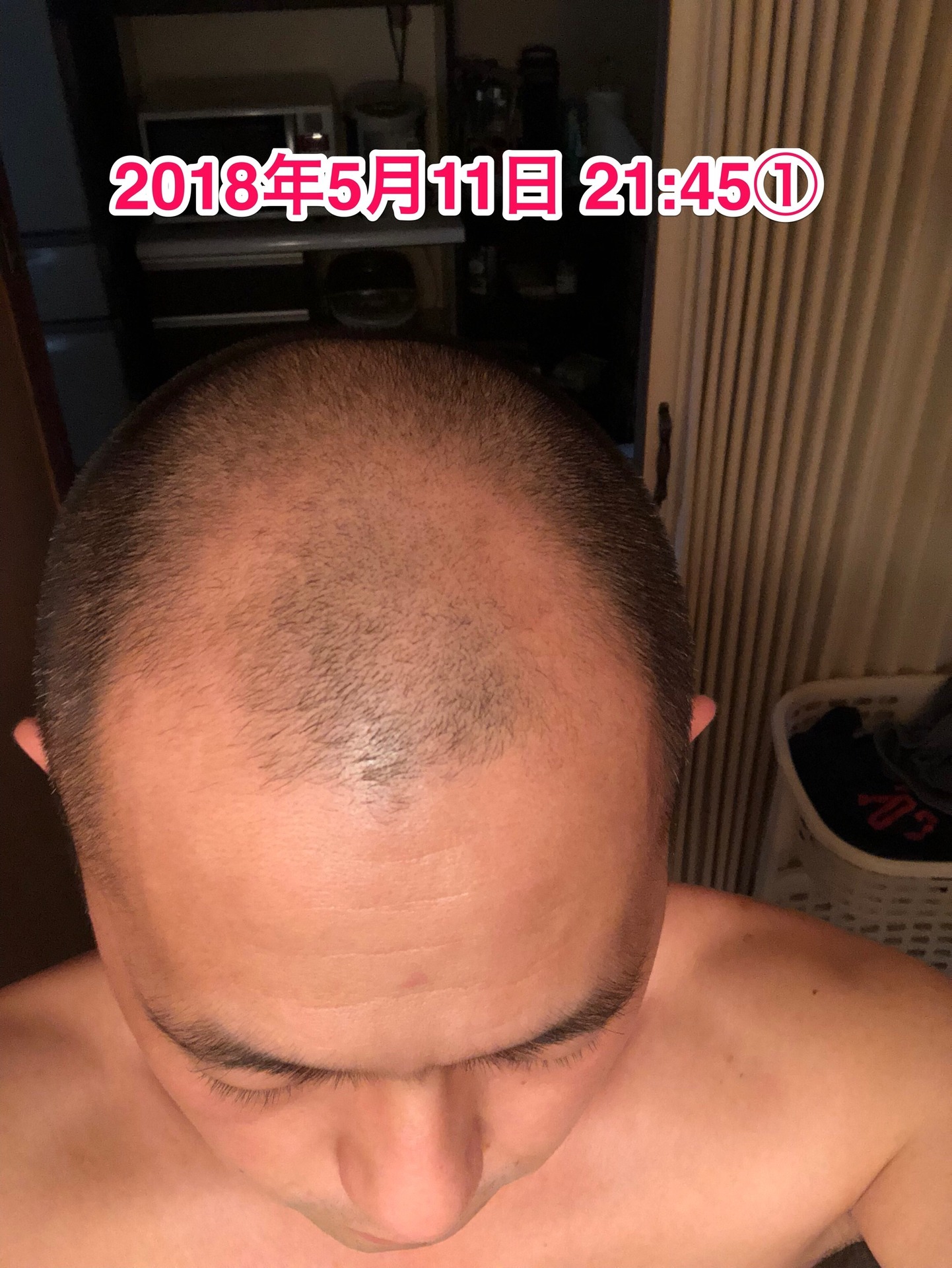 40代オヤジの頭髪を経過観察するブログ 18年5月11日 4本目突入から10日