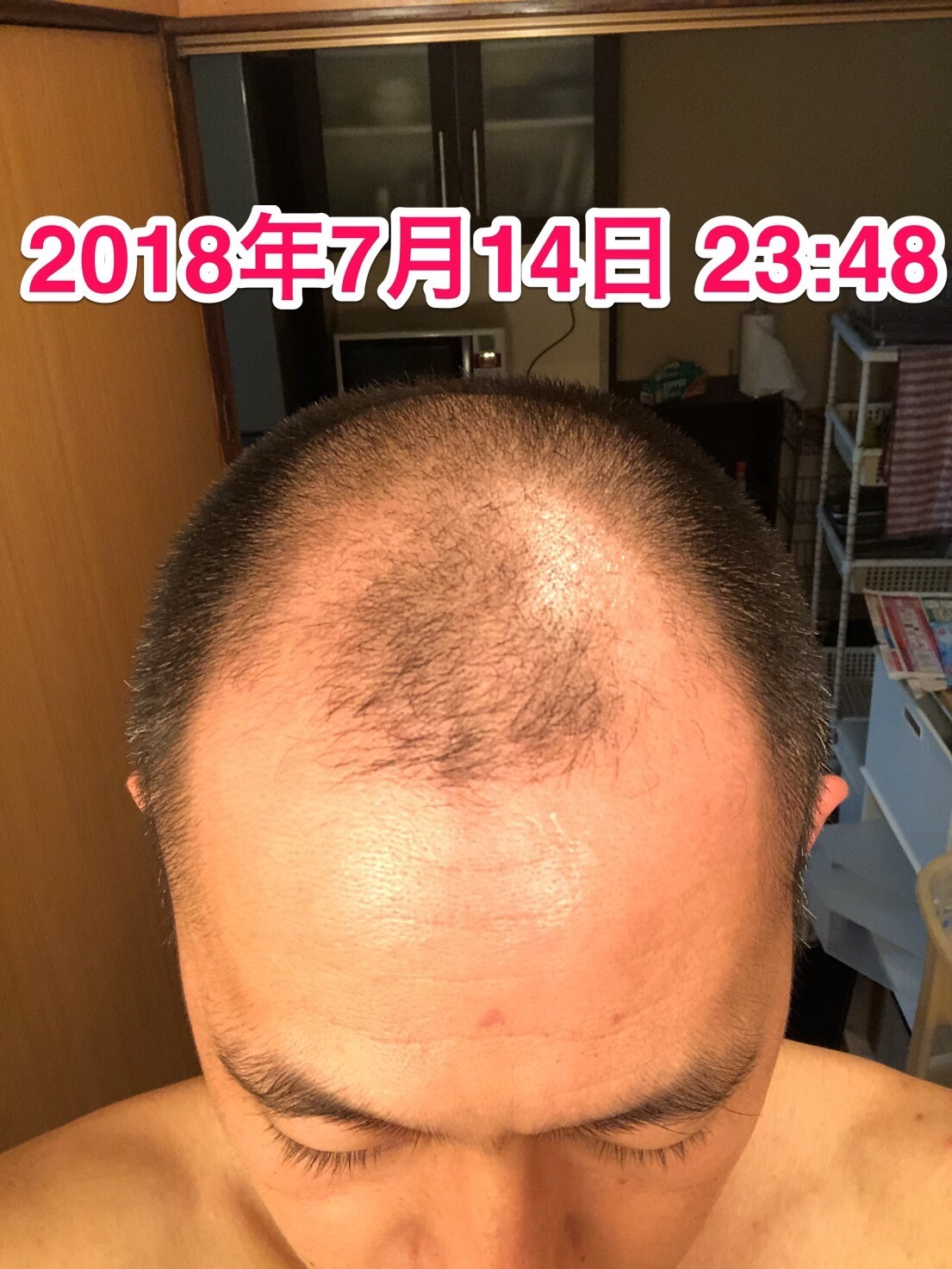 40代オヤジの頭髪を経過観察するブログ 18年7月14日 リアップ使用から約半年