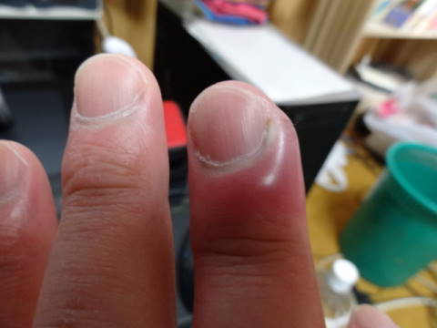 痛い さか むけ 指のささくれ（さかむけ）が痛いなら、指先の保湿が改善のカギ