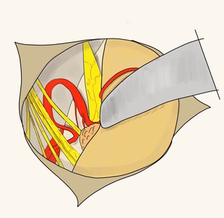 わかりやすい医学 顔面けいれん イラスト