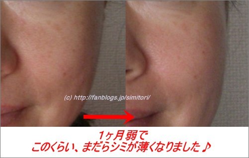 トリアスキンエイジングケアレーザーで顔のシミ取り中 写真付き体験談 トリアスキンエイジングケアレーザー１ヶ月の効果 写真付き口コミ