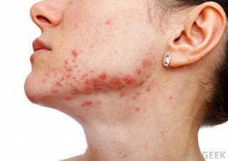 acne-on-chin.jpg