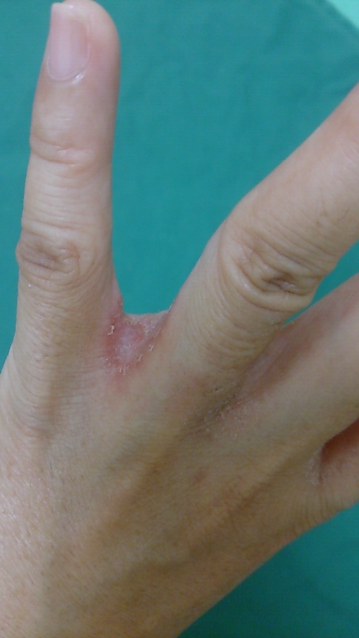 うつる 手 湿疹 手湿疹で水疱ができた！水疱はうつる？早く治す方法