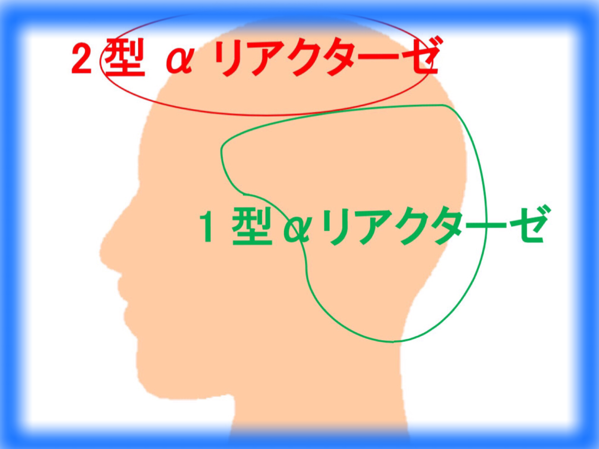 5分で見つかる Aga専門病院 本気で薄毛を治すなら モテハゲ なぜハゲるのか 原因とメカニズム