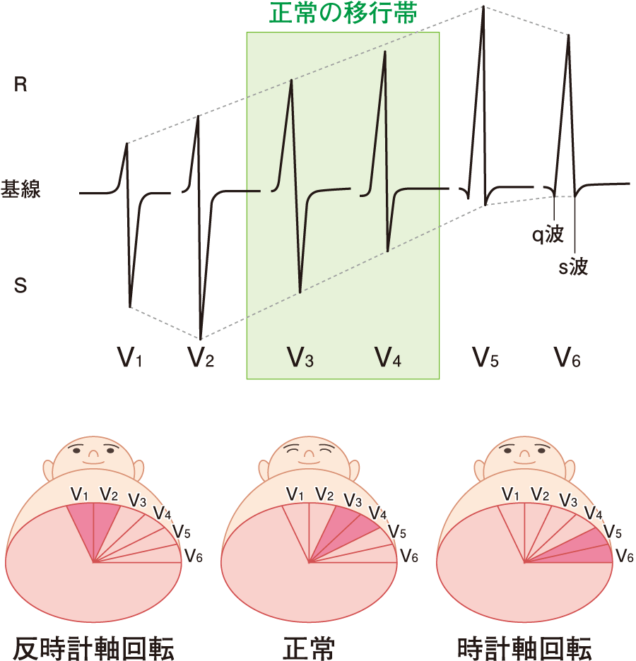 医師の心電図ブログ 心電図 Qrs平均電気軸 移行帯 右胸心