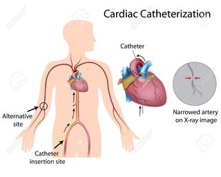 17754259-cardiac-catheterization-Stock-Photo.jpg