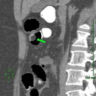 180108_A lipoma03.jpg