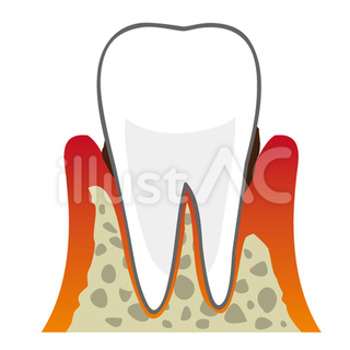 歯の炎症.jpg