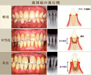 0520periodontitis01_2̂݁EaPA.jpg