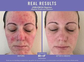 1867935f5438c89be1975bc963d5c7ea--rf-before-and-after-rodan-and-fields-before-and-after-unblemish.jpg